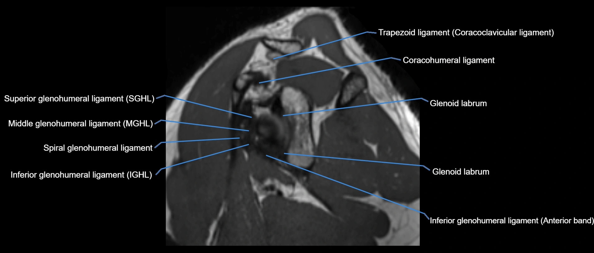 shoulder ligaments sagittal  cross sectional anatomy 3T MRI AI enhanced radiology image -img-00001-00025.webp